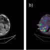 Zdjęcie (w orientacji poprzecznej) tomografii komputerowej (a) oraz złożenie obrazu z tomografu komputerowego i z tomografu emisyjnego pojedynczych fotonów (b) pacjenta z rakiem rdzeniastym tarczycy, przy znakowaniu galem-68. Zdjęcia wykonano 4h od podania mniejszej, niż przy znakowaniu indem, dawki peptydu. Strzałkami zaznaczono przerzuty nowotworowe w wątrobie.  Zdjęcie wykonano w Collegium Medicum Uniwersytetu Jagiellońskiego. Właścicielem zdjęcia jest MDPI, Basel, Switzerland; opublikowano w ramach lice